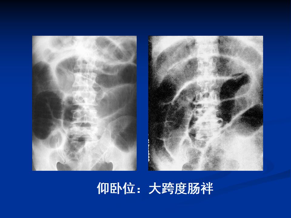 详细肠梗阻的分类及影像学表现高清图片文字讲解