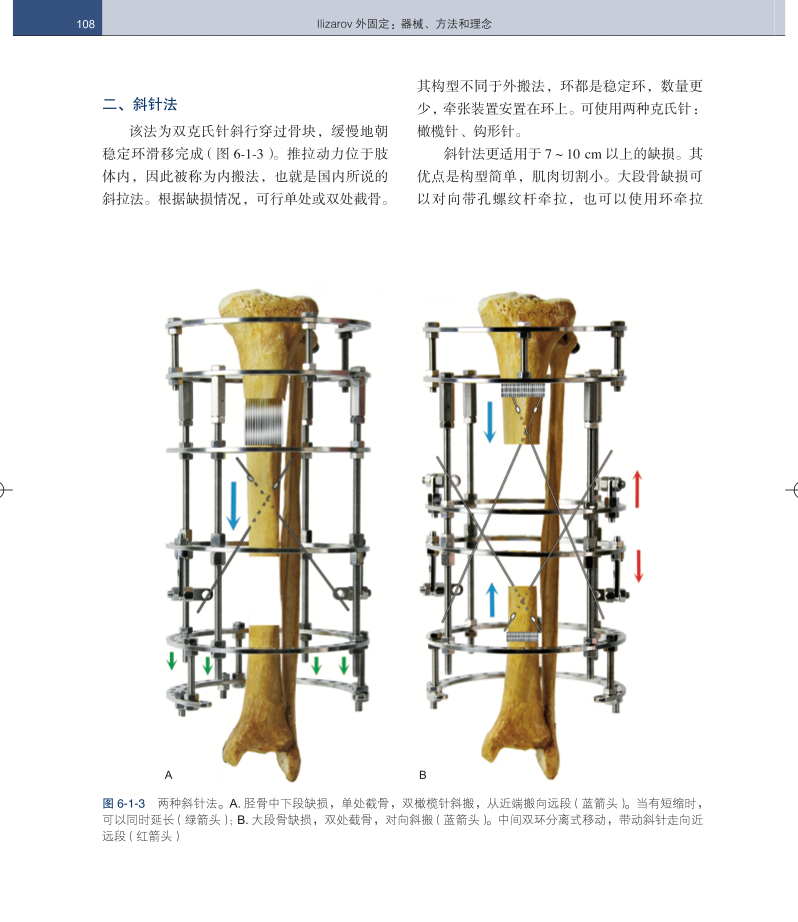 手术头灯眼镜怎么畅销书！Ilizarov 外固定：器械、方法和理念_https://www.jmylbn.com_新闻资讯_第11张