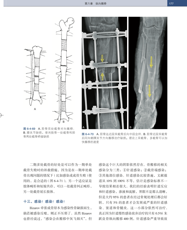 手术头灯眼镜怎么畅销书！Ilizarov 外固定：器械、方法和理念_https://www.jmylbn.com_新闻资讯_第13张