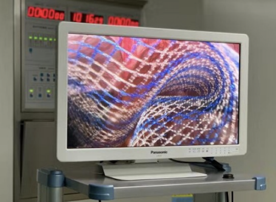 疝气 补片怎么选国产补片 ｜ 新华善修®轻型大网孔疝修补补片的九大优势_https://www.jmylbn.com_新闻资讯_第7张