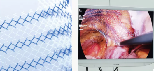疝气 补片怎么选国产补片 ｜ 新华善修®轻型大网孔疝修补补片的九大优势_https://www.jmylbn.com_新闻资讯_第6张