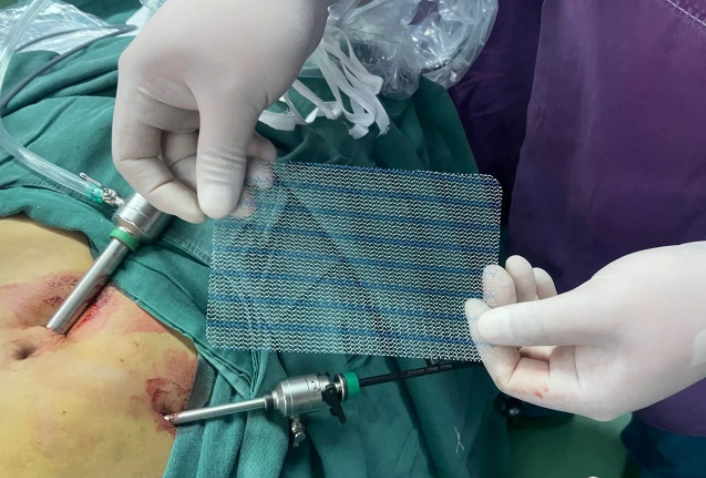 疝气补片怎么用疝外科小科普 ｜ 了解一下腹腔镜疝修补术用的“补片”吧！_https://www.jmylbn.com_新闻资讯_第3张