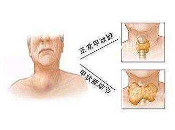 查出了甲状腺结节,会不会癌变? 查出了甲状腺结节,会不会癌变?
