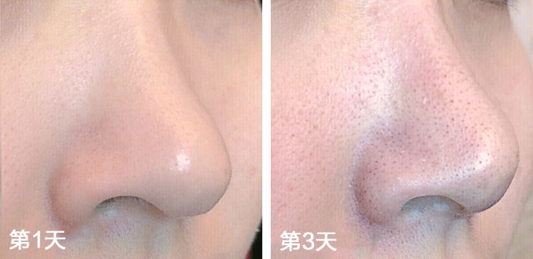 



黑头千万别挤！用这招清掉10年黑头，从此黑头不爱长！
