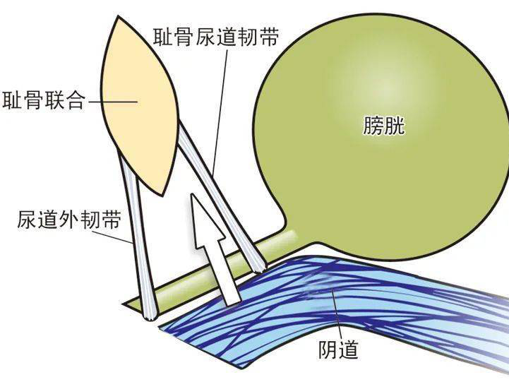 尿道张力过强怎么压力性尿失禁不可怕，三种方法消灭尴尬_https://www.jmylbn.com_新闻资讯_第20张