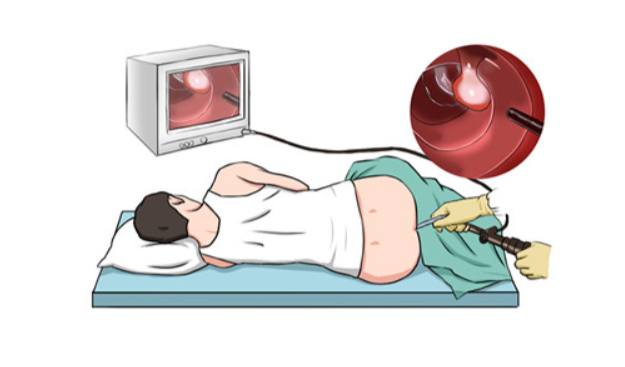 无痛胃肠镜是怎么做到「无痛」的?