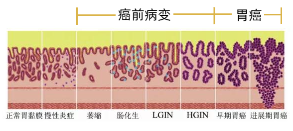 得胃癌之前胃都经历了什么