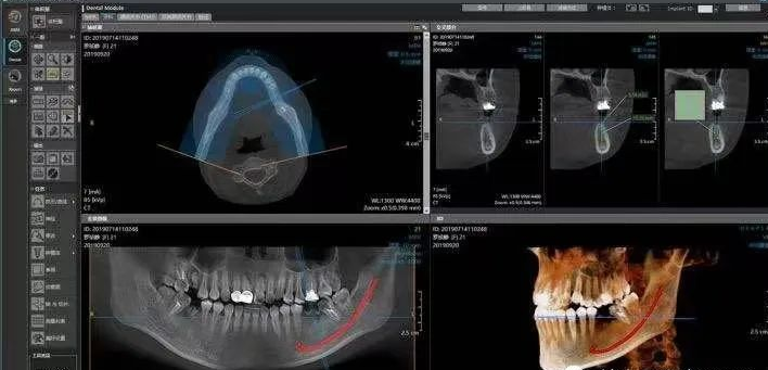 什么牌子口腔ct最好一次口腔CT，看清更多隐患！我院新引进卡瓦口腔三合一CBCT投入使用_https://www.jmylbn.com_新闻资讯_第9张