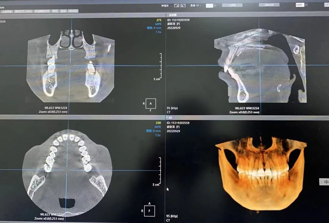 什么牌子口腔ct最好一次口腔CT，看清更多隐患！我院新引进卡瓦口腔三合一CBCT投入使用_https://www.jmylbn.com_新闻资讯_第6张