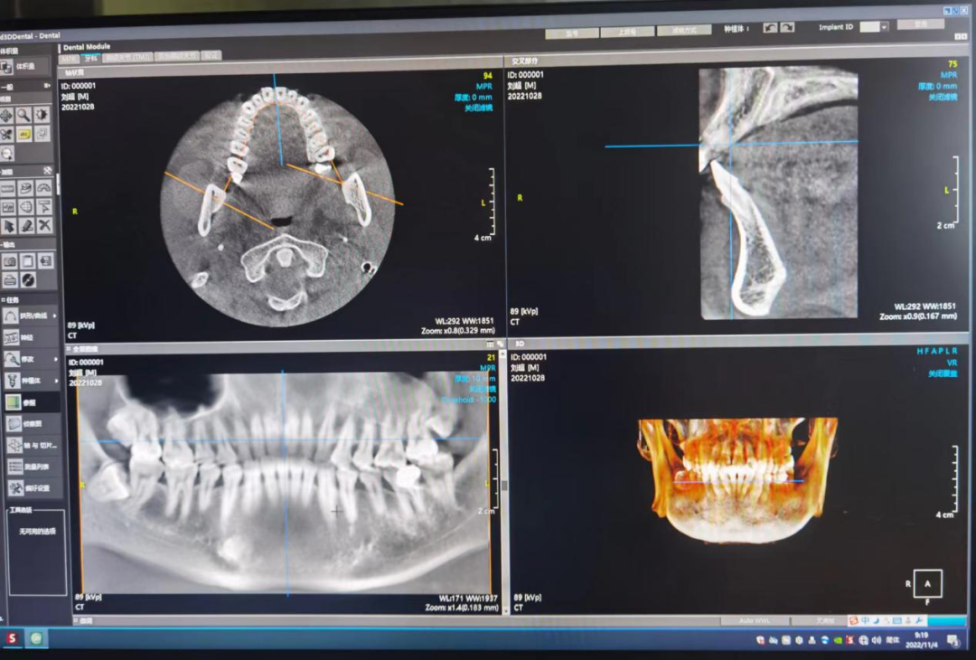 什么牌子口腔ct最好一次口腔CT，看清更多隐患！我院新引进卡瓦口腔三合一CBCT投入使用_https://www.jmylbn.com_新闻资讯_第4张