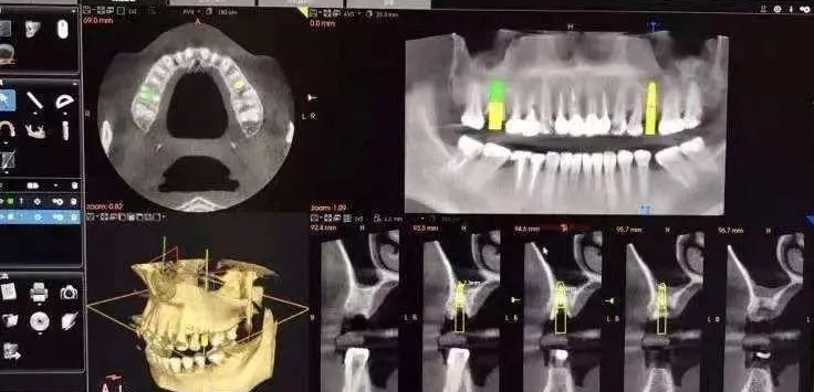 什么牌子口腔ct最好一次口腔CT，看清更多隐患！我院新引进卡瓦口腔三合一CBCT投入使用_https://www.jmylbn.com_新闻资讯_第7张