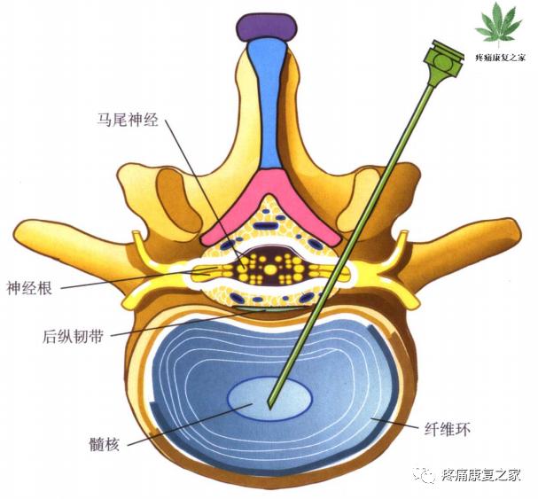 射频什么科【图文版】射频治疗技术疼痛科专家共识_https://www.jmylbn.com_新闻资讯_第15张
