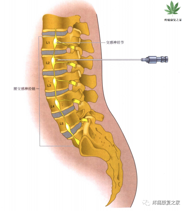射频什么科【图文版】射频治疗技术疼痛科专家共识_https://www.jmylbn.com_新闻资讯_第13张