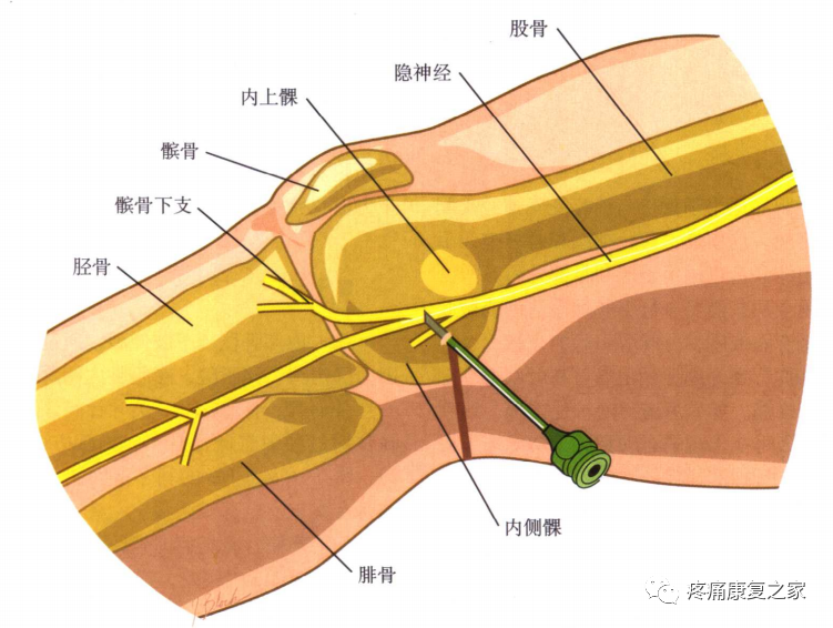 射频什么科【图文版】射频治疗技术疼痛科专家共识_https://www.jmylbn.com_新闻资讯_第19张