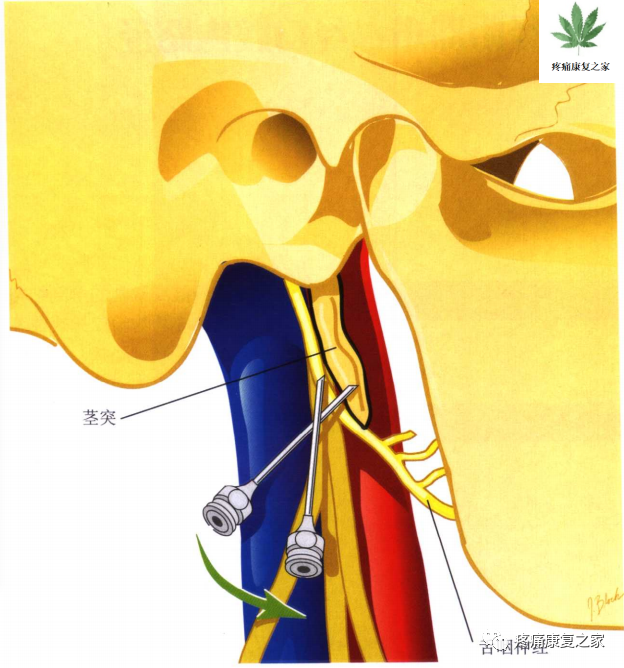 射频什么科【图文版】射频治疗技术疼痛科专家共识_https://www.jmylbn.com_新闻资讯_第8张