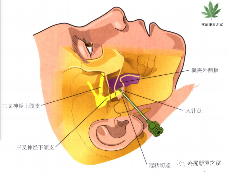 射频什么科【图文版】射频治疗技术疼痛科专家共识_https://www.jmylbn.com_新闻资讯_第6张