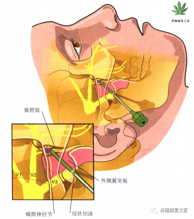 射频什么科【图文版】射频治疗技术疼痛科专家共识_https://www.jmylbn.com_新闻资讯_第12张