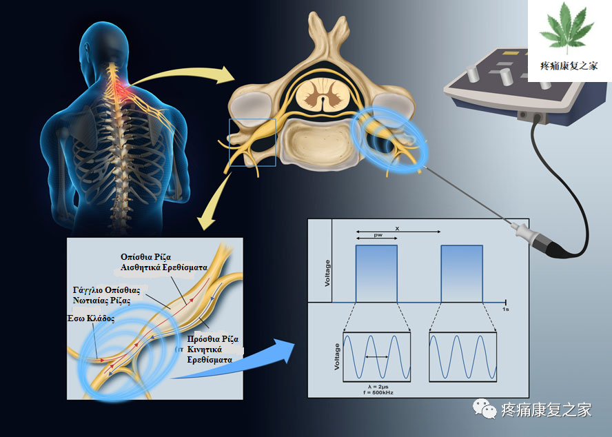 射频什么科【图文版】射频治疗技术疼痛科专家共识_https://www.jmylbn.com_新闻资讯_第1张