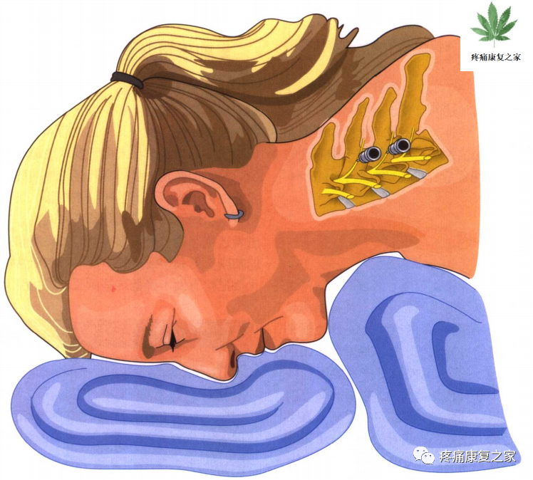 射频什么科【图文版】射频治疗技术疼痛科专家共识_https://www.jmylbn.com_新闻资讯_第9张