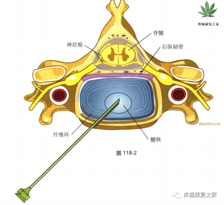 射频什么科【图文版】射频治疗技术疼痛科专家共识_https://www.jmylbn.com_新闻资讯_第14张