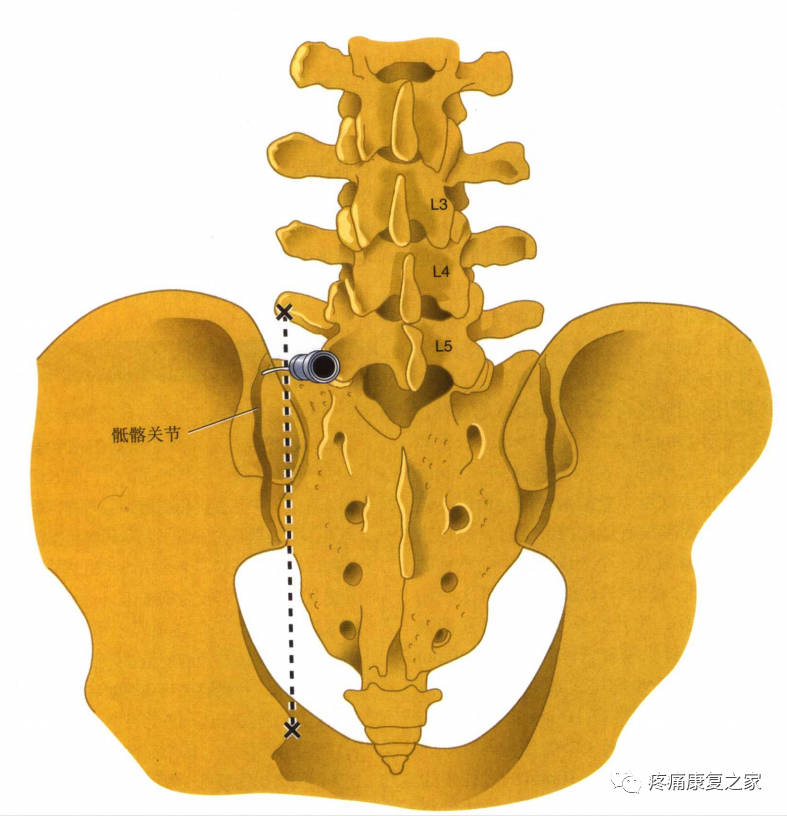 射频什么科【图文版】射频治疗技术疼痛科专家共识_https://www.jmylbn.com_新闻资讯_第17张