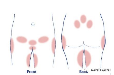 骨盆带痛,会对生活造成哪些影响?骨盆功能障碍到底有哪些症状?