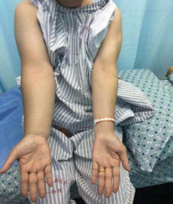 压力绷带为什么那么贵【悦护理】乳腺癌术后手肿怎么办？综合消肿疗法来帮忙！_https://www.jmylbn.com_新闻资讯_第2张