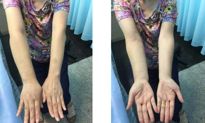 压力绷带为什么那么贵【悦护理】乳腺癌术后手肿怎么办？综合消肿疗法来帮忙！_https://www.jmylbn.com_新闻资讯_第5张