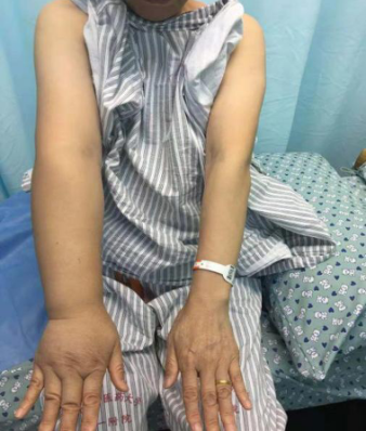 压力绷带为什么那么贵【悦护理】乳腺癌术后手肿怎么办？综合消肿疗法来帮忙！_https://www.jmylbn.com_新闻资讯_第3张