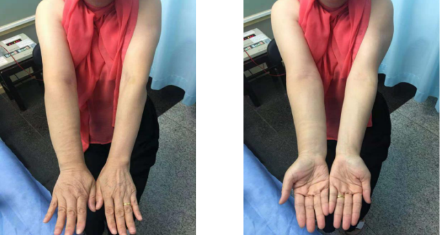 压力绷带为什么那么贵【悦护理】乳腺癌术后手肿怎么办？综合消肿疗法来帮忙！_https://www.jmylbn.com_新闻资讯_第4张