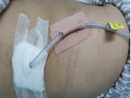 尿液引流袋怎么用悦护理 ｜ “肾造瘘管”的自白_https://www.jmylbn.com_新闻资讯_第4张