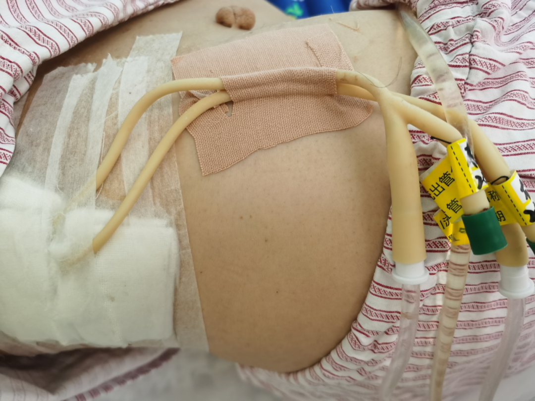 尿液引流袋怎么用悦护理 ｜ “肾造瘘管”的自白_https://www.jmylbn.com_新闻资讯_第5张