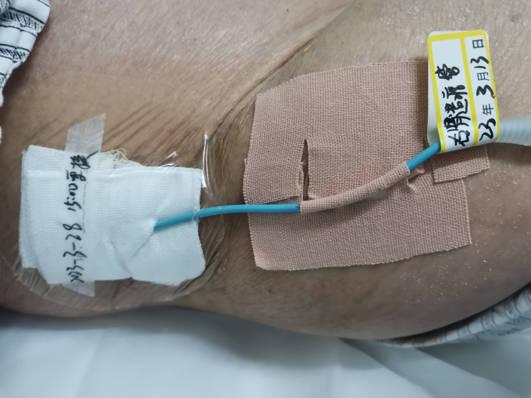 尿液引流袋怎么用悦护理 ｜ “肾造瘘管”的自白_https://www.jmylbn.com_新闻资讯_第6张