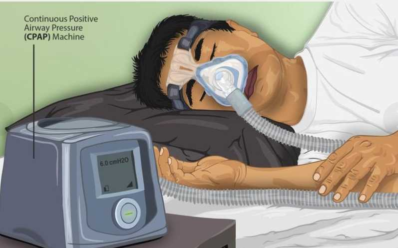 呼吸机ac是什么意思阻塞性睡眠呼吸暂停的呼吸机治疗你了解吗？_https://www.jmylbn.com_新闻资讯_第3张