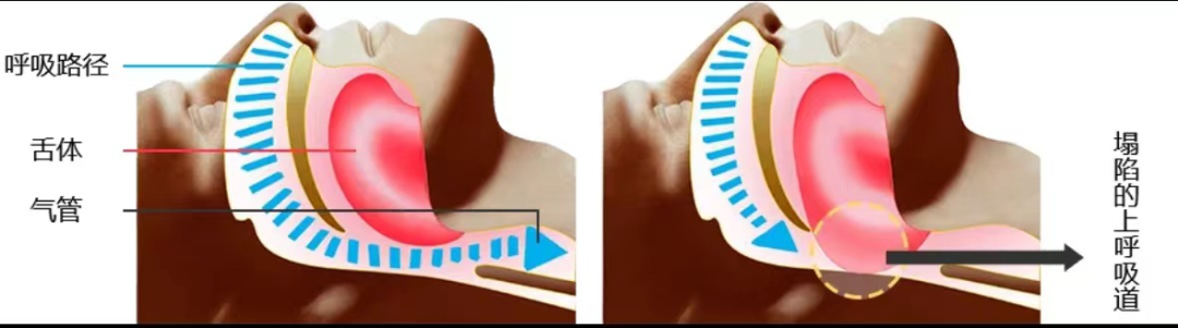 呼吸机ac是什么意思阻塞性睡眠呼吸暂停的呼吸机治疗你了解吗？_https://www.jmylbn.com_新闻资讯_第2张