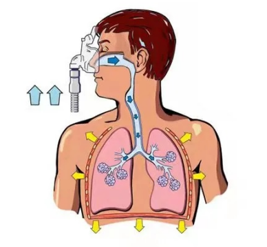 呼吸机ac是什么意思阻塞性睡眠呼吸暂停的呼吸机治疗你了解吗？_https://www.jmylbn.com_新闻资讯_第4张