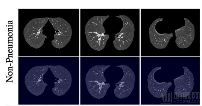 深度學習判別新冠肺炎準確率達九成，《Radiology》已收錄相關研究成果