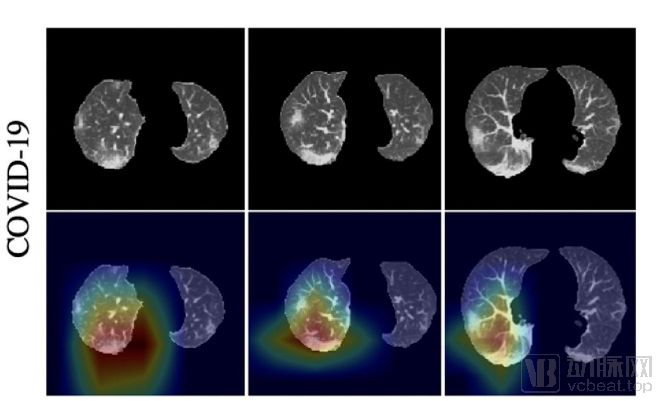 深度學習判別新冠肺炎準確率達九成，《Radiology》已收錄相關研究成果