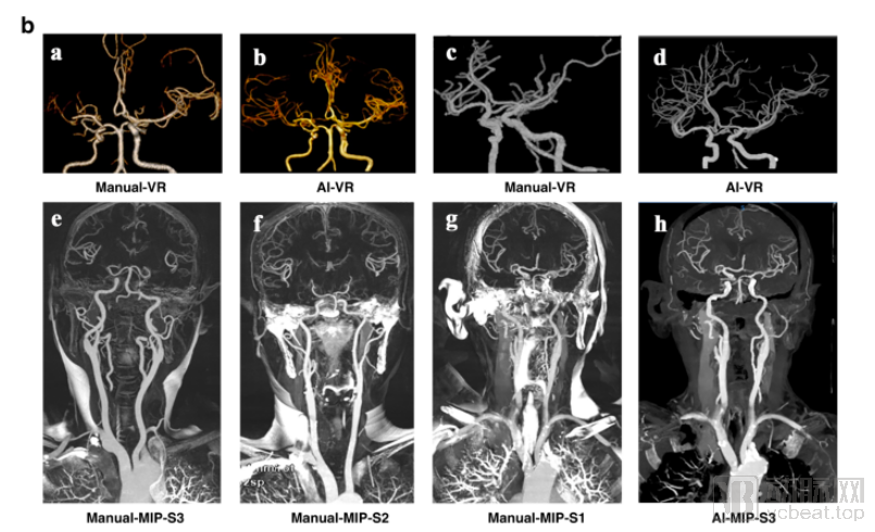 《Nature》子刊收錄宣武醫院頭頸CTA血管重建最新成果，AI重塑臨床流程