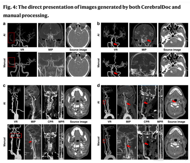 《Nature》子刊收錄宣武醫院頭頸CTA血管重建最新成果，AI重塑臨床流程