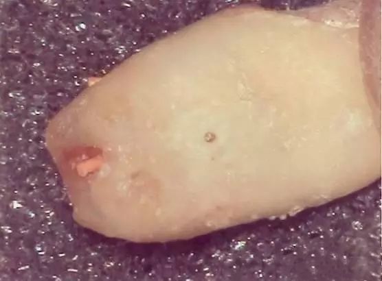 牙胶尖什么颜色正确选择处理主牙胶尖_https://www.jmylbn.com_新闻资讯_第5张