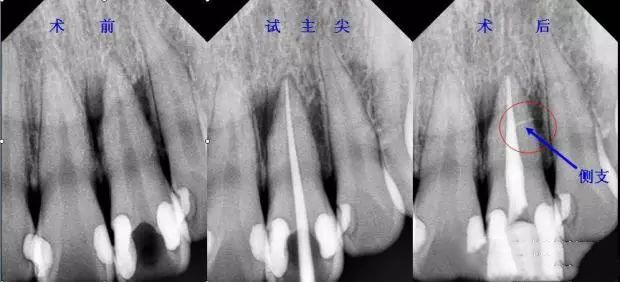 牙胶尖什么颜色正确选择处理主牙胶尖_https://www.jmylbn.com_新闻资讯_第3张