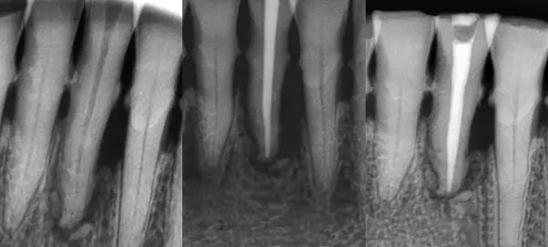 牙胶尖什么颜色正确选择处理主牙胶尖_https://www.jmylbn.com_新闻资讯_第2张