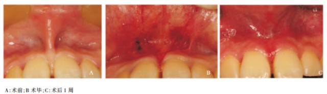 口腔激光怎么治疗谈谈激光在口腔治疗中的华丽现身_https://www.jmylbn.com_新闻资讯_第6张