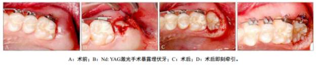 口腔激光怎么治疗谈谈激光在口腔治疗中的华丽现身_https://www.jmylbn.com_新闻资讯_第7张