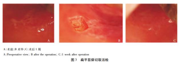 口腔激光怎么治疗谈谈激光在口腔治疗中的华丽现身_https://www.jmylbn.com_新闻资讯_第4张