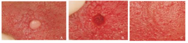 口腔激光怎么治疗谈谈激光在口腔治疗中的华丽现身_https://www.jmylbn.com_新闻资讯_第5张