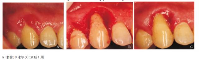 口腔激光怎么治疗谈谈激光在口腔治疗中的华丽现身_https://www.jmylbn.com_新闻资讯_第3张