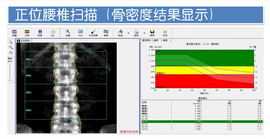 骨密度影是什么台江县民族中医院影像科再添“新成员”——双能X线骨密度检测仪！_https://www.jmylbn.com_新闻资讯_第8张