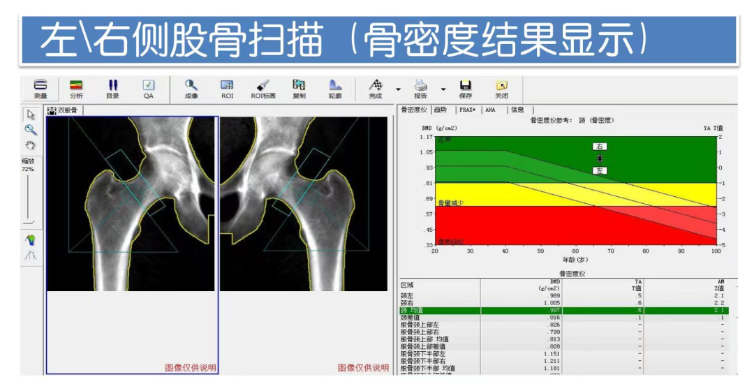 骨密度影是什么台江县民族中医院影像科再添“新成员”——双能X线骨密度检测仪！_https://www.jmylbn.com_新闻资讯_第9张